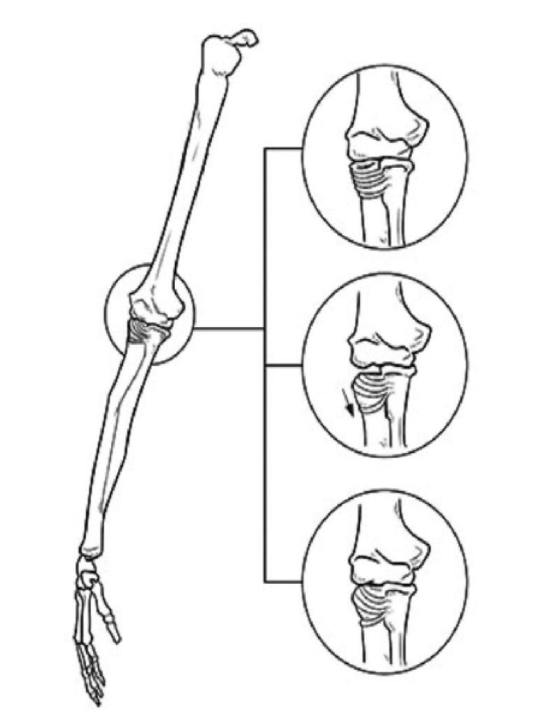 Cirugía de Hombro en Guadalajara | Dr. Esteban Castro - Ortopedia y traumatología | Cirugía articular Subluxación de cabeza de radio