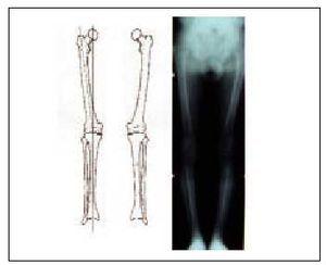 Cirugía de Hombro en Guadalajara | Dr. Esteban Castro - Ortopedia y traumatología | Cirugía articular Gonartrosis