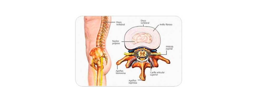 Hernia de disco lumbar