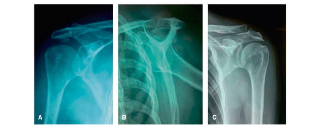 Cirugía de Hombro en Guadalajara | Dr. Esteban Castro - Ortopedia y traumatología | Cirugía articular Lesión del manguito rotador