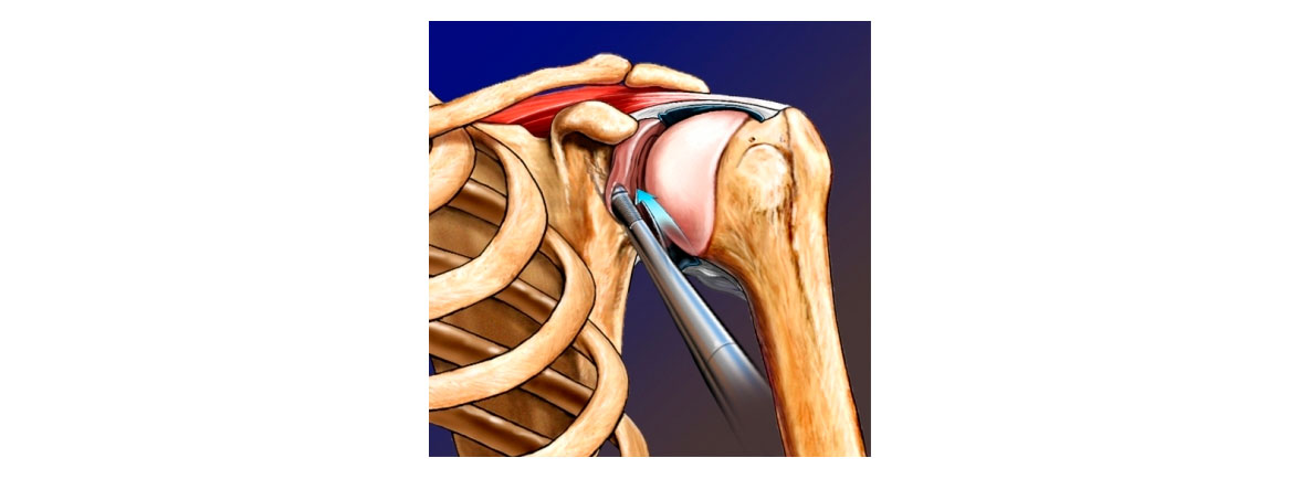 ¿Qué es el Labrum del Hombro?