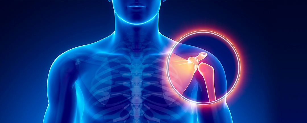 Lesiones de hombro en Guadalajara
