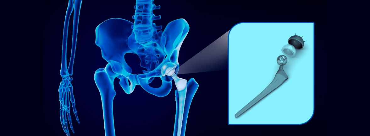 Cirugía de Hombro en Guadalajara | Dr. Esteban Castro - Ortopedia y traumatología | Cirugía articular Cirugía Ortopédica General en Guadalajara Cirugía Ortopédica General en Guadalajara