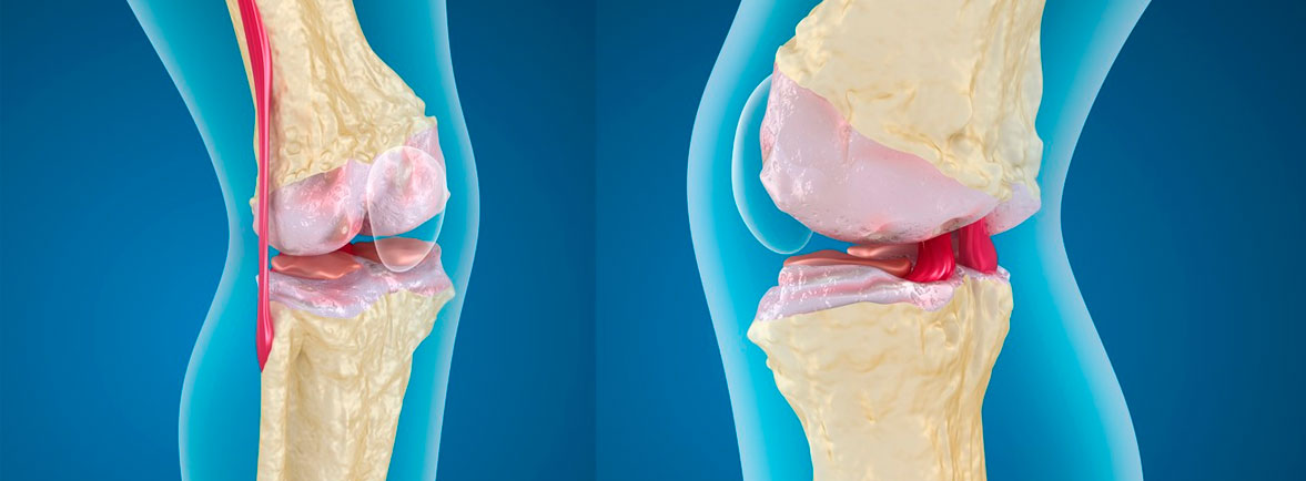 Cirugía de Rodilla en Zapopan - Cirugía de Hombro en Guadalajara | Dr ...