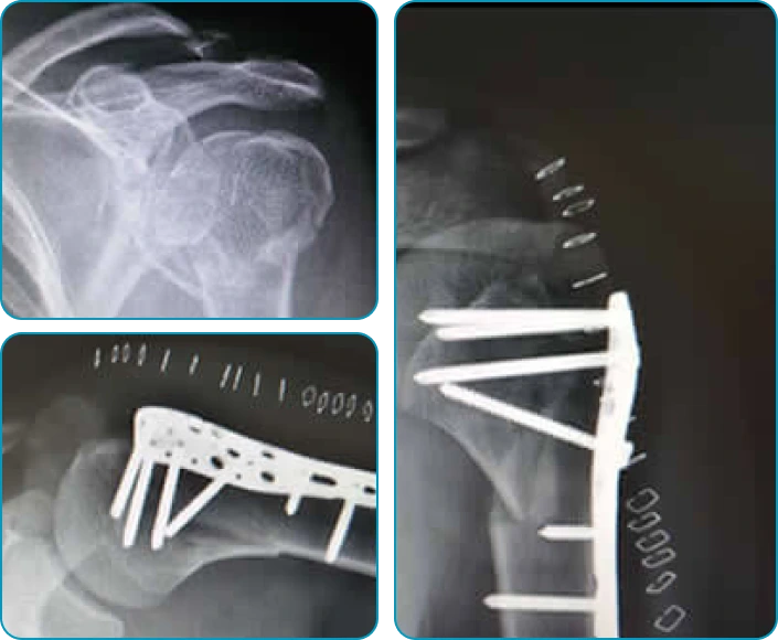 Cirugía de Hombro - Traumatólogo y Ortopedista