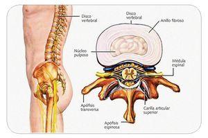 Hernia de disco cervical