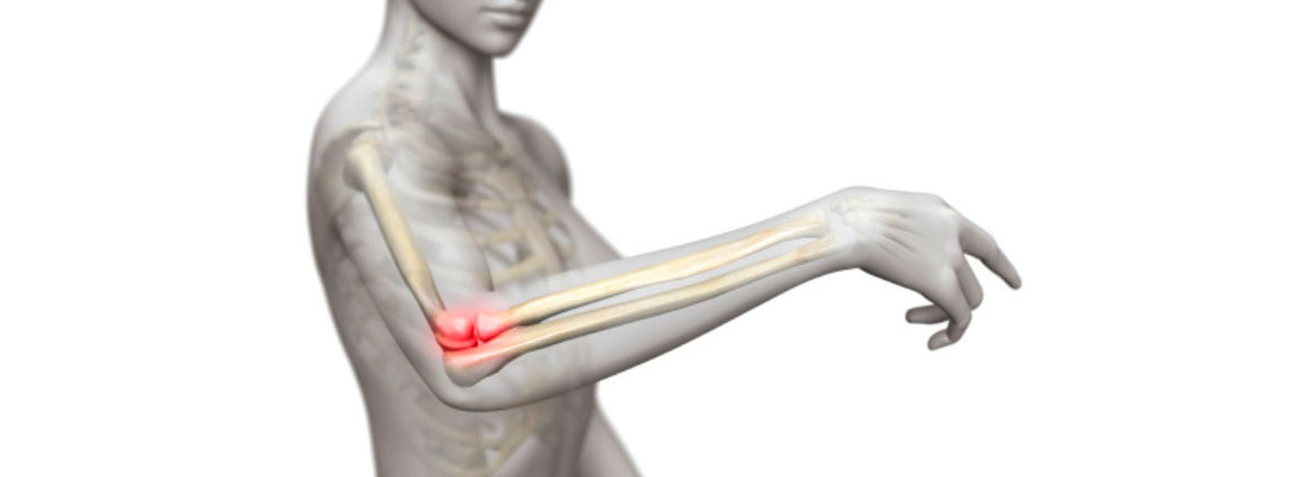 Epicondilitis lateral