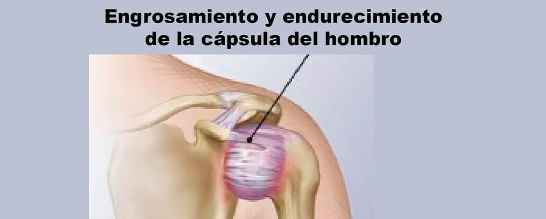 Capsulitis adhesiva, Hombro congelado