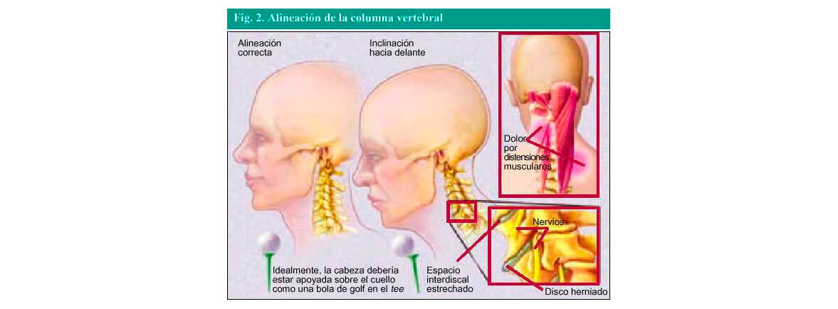 Cervicalgia