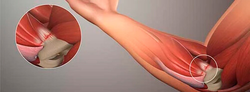 Epitrocleitis