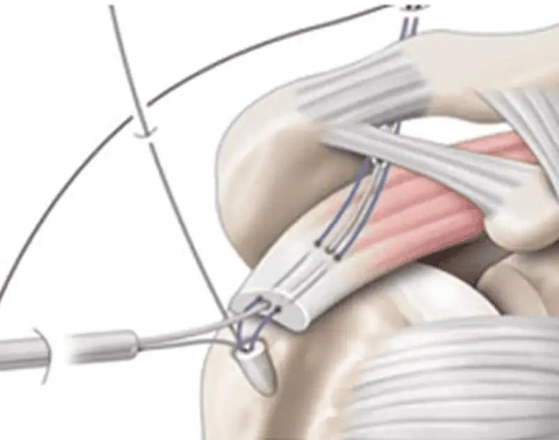 Cirugía de Hombro en Guadalajara | Dr. Esteban Castro - Ortopedia y traumatología | Cirugía articular Cirugía de hombro Cirugía de Hombro en Guadalajara | Dr. Esteban Castro - Ortopedia y traumatología | Cirugía articular Cirugía de hombro