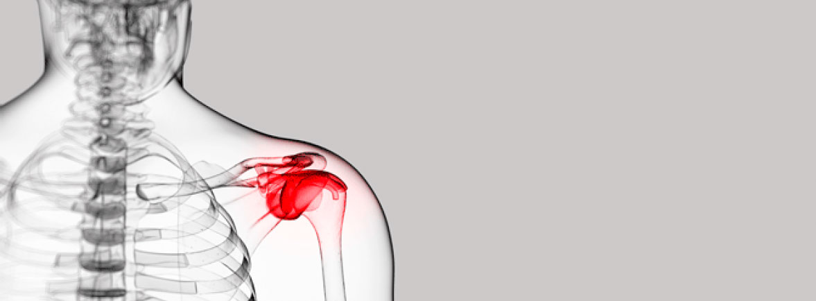 Capsulitis Adhesiva