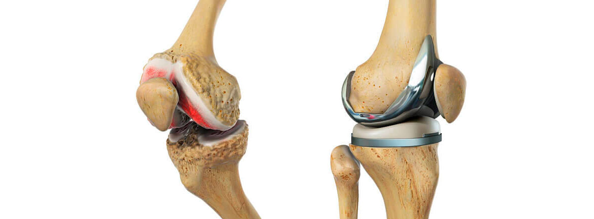 Artroplastia total de rodilla en Guadalajara