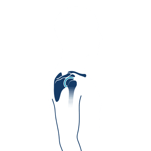 Cirugía de Hombro en Guadalajara | Dr. Esteban Castro - Ortopedia y traumatología | Cirugía articular Inicio