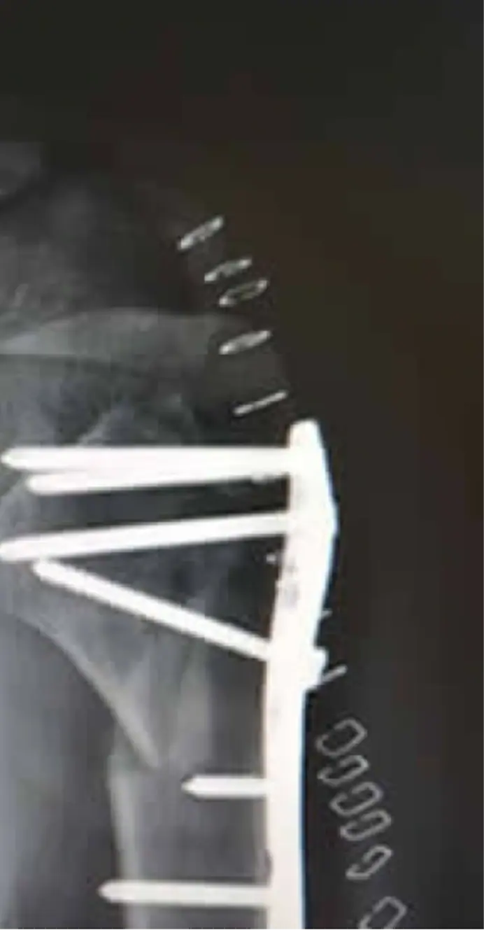 Radiografía de hombro mostrando placas y tornillos de osteosíntesis por cirugía ortopédica en Guadalajara