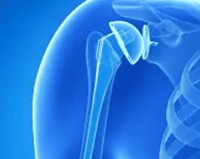 Cirugía de Hombro en Guadalajara | Dr. Esteban Castro - Ortopedia y traumatología | Cirugía articular Cirugía de hombro Esquema anatómico de reemplazo articular o prótesis de hombro