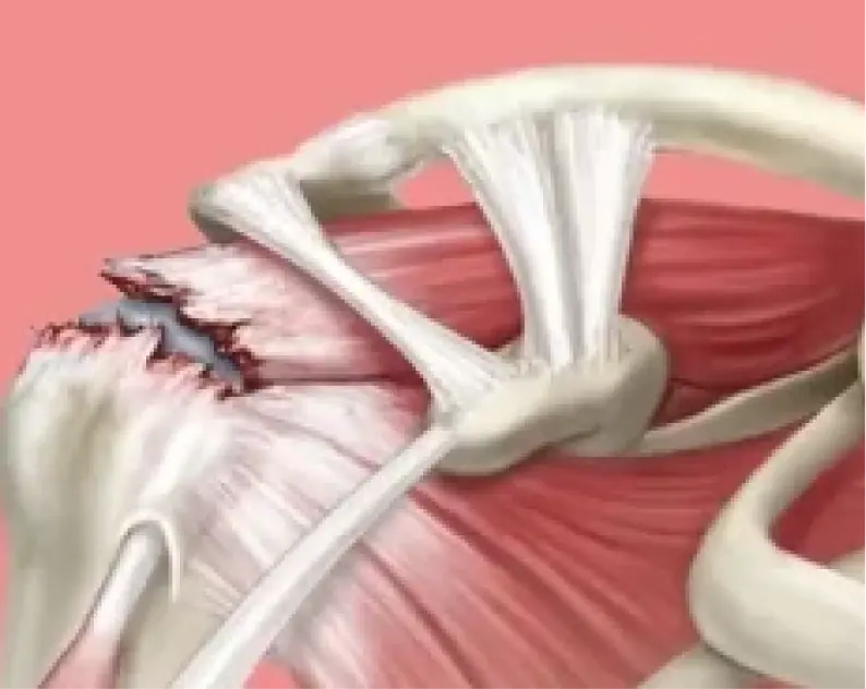 Cirugía de Hombro en Guadalajara | Dr. Esteban Castro - Ortopedia y traumatología | Cirugía articular Cirugía de hombro Ilustración médica de la reparación quirúrgica del manguito rotador en el hombro